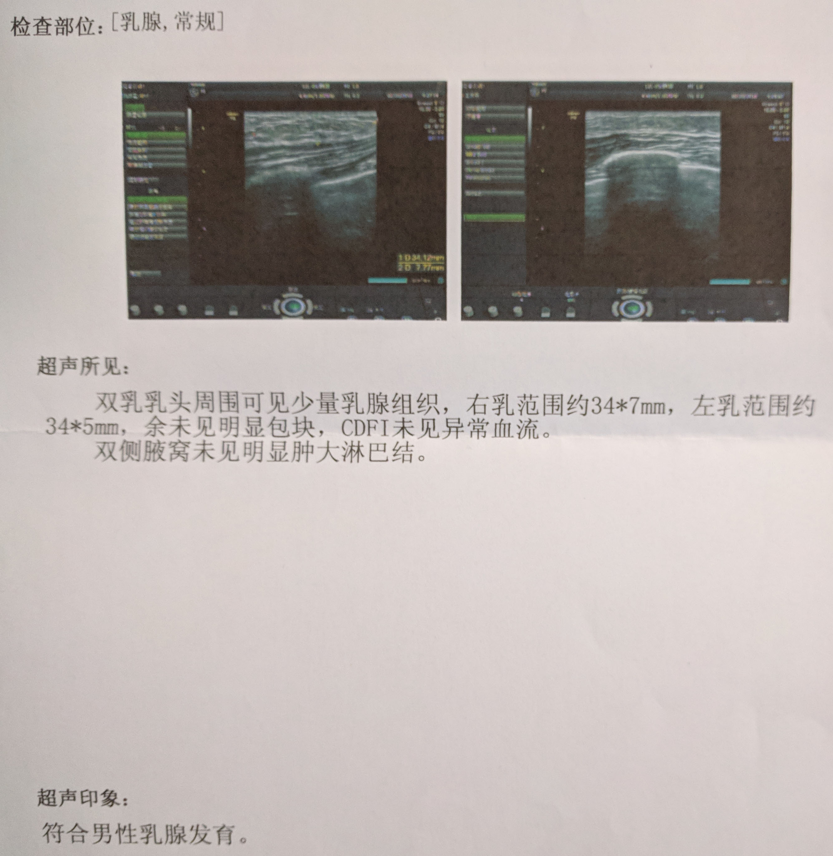 冒着社会性死亡的风险上奶照,问下关于男性乳头雌化的