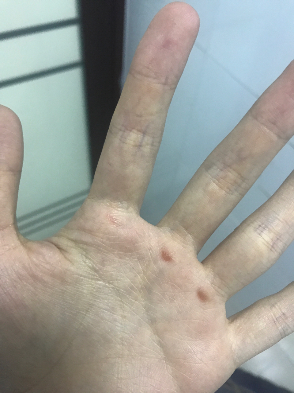 这个手上的茧子颜色怎么这么奇怪?